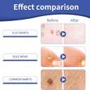 2 x Likluc Fast-Acting Wart Remover Gel with Freeze Off Technology - Genital, Common Warts & Plantar wart Remover for Feet, Skin & More