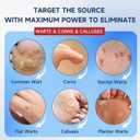 3 x NewX Fast Action Wart Gel Maximum Strength - Wart with Salicylic Acid - Fast-Acting Wart Freeze Off Designed for Warts, Plantar Wart, Genital Wart, Common Wart, Flat Wart, Corn, Callus-G-03