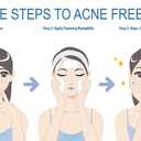 Acne Treatment For Sensitive Skin - 80% of Acne Gone in 4 Weeks. Pimple Cream Stops Face Acne and Teen Acne Without Drying or Irritating Skin. Zit Cream, Face Toner for Pimple Prone Skin.