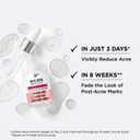 IT Cosmetics Bye Bye Breakout Acne Treatment Face Serum -With 2% Salicylic Acid & 3% Lactic Acid - Helps Reduce Pimples in 3 Days & Fades Look of Post-Acne Marks in 8 Weeks - 1 Fl. Oz