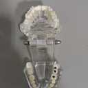 Transparent Disease Teeth Model with Dental Implant Bridge, Dental Model for Patient and Dental Student Education