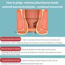 Hemorrhoid Care Cream - Relief for Pain, Itching, Burning & Swelling - Soothes Irritated Skin - 0.7oz (20g)