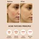 Pimple Patches for Acne (300 Count, 4 Sizes)  Hydrocolloid Zit Stickers with Salicylic Acid, Tea Tree & Calendula  Invisible Overnight Acne Patches for Fast Healing & Clear Skin
