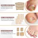 2 x Ingrown Toenail Removal Kit, Professional Ingrown Toenail tool Kit with Ingrown Toenail Corrector, 50PCS Ingrown Toenail Corrector Patch & 30PCS Toenail Corrector Strips for Toe Pain Relief (1 Count (Pack of 1))