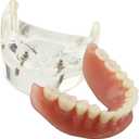 Dental Model Overdenture Inferior 2 Implants Demo for Studying and Teaching