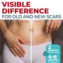 Medical Grade Silicone Scar Tape - 1.6x150 - Visible Difference on Keloid & -Section - Reusable Silicone Scar Sheets - Easy to Use
