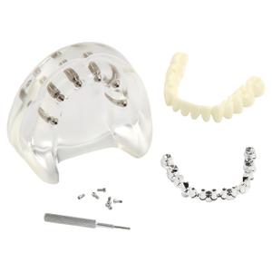 Dental Implant Model Transparent Upper Jaw with 6 Implants and Removable Screws for Overdenture Restoration Dental School Teaching Lab Demo and Patient Education