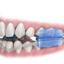 DenTek ComfortFit Dental Guard, Mouth Guard for Grinding Teeth at Night, Pack of 2 Guards & 1 Storage Case