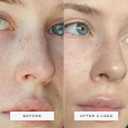 Vue Hydrocolloid Nose Patches - Nose Pore Strips for Blackheads, Sebum and Oil Control, Gentle for All Skin Types (8-Count)