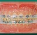 Morgan Bumper Braces Cover Lip Protector for Orthodontic Patients - Clear - Qty 2