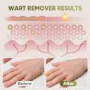 2 x "STAY STOKED" Wart Remover, Maximum Strength Wart Remover Freeze Off - Heavy-Duty Treatment for Stubborn Plantar Warts, Corns & Common Warts, Fast Results in 1-2 Weeks-H5516