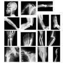 15 Pcs Broken Bones x Ray Set Human x Rays Black and White Skeleton Pretend Xrays for Kids