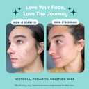 Proactiv 3 Step Acne Treatment - Benzoyl Peroxide Face Wash, Repairing Acne Spot Treatment for Face and Body, Exfoliating Toner - 30 Day Complete Acne Skin Care Kit