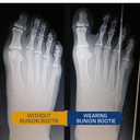 Bunion Corrector for Women Big Toe, Men Too  Ultra-Thin Separator Sock for Bunions. Correction & Pain Relief While You Walk. Splint That Fits in Dress Shoes, Sneakers & Boots. Med-Right