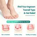 Ingrown Toenail Treatment, 60 Pcs Breathable Ingrown Toenail Strips, Painless Toenail Support Tool for At-Home Pedicure and Foot Care, Toenail Corrector Patch 60 Count (Pack of 1)