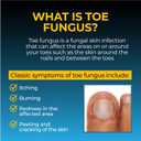 Fungi-Nail Anti-Fungal Liquid Solution, 1 Fl Oz (Pack of 1), Kills Fungus, Athletes Foot Treatment, Toe Nail Fungus Treatments w/Tolnaftate, Clinically Proven to Cure and Prevent Fungal Infection