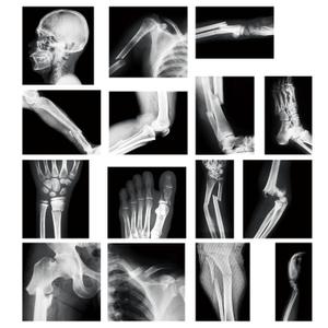 15 Pcs Broken Bones x Ray Set Human x Rays Black and White Skeleton Pretend Xrays for Kids