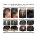 Laser Comb, FDA Cleared Device, Red Light Therapy for Hair Growth, Professional Grade Hair Loss Treatment, Regrows Fuller and Thicker Hair, Reverses Thinning, Stimulates Growth for Men & Women