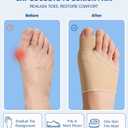 2 x MasterMo 2 PCS Bunion Corrector for Women & Men - Professional Big Toe Straightener with Non-Slip Heel Strap, Breathable Bunion Splint & Relief Socks for Hallux Valgus, Day & Night Support (Nude, L)