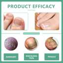 Nail Fungus PenToenail Fungus Treatment Extra Strength for Toe Nail Repair Pen for Damaged Nails - 25% Undecylenic Acid with added Tea Tree Oil(3 PCS)