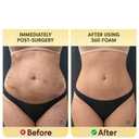 Post Surgery 360 Lipo Foam Wrap Around | Tummy Tuck Binder Post Surgery | Soft & Breathable Material, 360 Wrap around Liposuction | BBL Post Surgery Supplies (Medium)