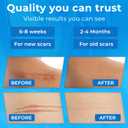 3 x Silicone Scar Sheets Roll (1.6"x158" 4m) - Reusable Waterproof Scar Tape, Strips for C-Section, Surgery, Keloid, Burn & Acne Scars Removal