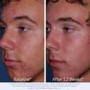 Obagi CLENZIderm M.D. Daily Care Foaming Acne Cleanser  Acne Treatment with 2% Salicylic Acid (BHA)