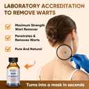 6 x "STAY STOKED" Wart Remover, 15ml Fast-Acting Wart Freeze Off with Natural Herbal Extracts - Gentle Yet Powerful for Common Warts, Plantar Warts on Hands/Feet-0123