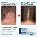 Scalp Soothing Cream, Calming Relief for Dry Itchy Irritated , Moisturizes & Repairs Barrier, Anti-Dandruff Care, TypesSeborrheic Dermatitis Scalp Treatment & Stimulating Scalp Hair Balm