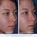 Obagi CLENZIderm M.D. Daily Care Foaming Acne Cleanser  Acne Treatment with 2% Salicylic Acid (BHA)