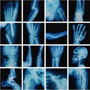 16 Pcs Realistic Broken Bones X-Ray Set - Blue & Black Skeleton X-Rays for Kids (9.8"x9.8") - Pretend Play Doctor Kit Learning Toy, Halloween & Medical School Supplies