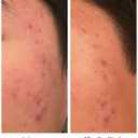 Acne Treatment For Sensitive Skin - 80% of Acne Gone in 4 Weeks. Pimple Cream Stops Face Acne and Teen Acne Without Drying or Irritating Skin. Zit Cream, Face Toner for Pimple Prone Skin.