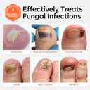 2 x modelones Toenail Fungus Treatment Extra Strength 7days Nail Fungus Treatment for Toenail and Fingernail With Brushes Head Nail Repair for Damaged Nails Antifungal Nail Polish 30ML 1Fl Oz