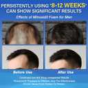 Minoxidil 5% Foam for Men Hair Growth Foam Suitable for Hair, Pack of 3