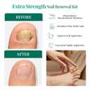 APUREE Fungal Nail Patches Extra Strength: Max 1% Tolnaftate | FSA-HSA | 8H Overnight Toenail Treatment |Repair For Discolored Yellow Brittle Damage Nails| Restores Healthy Appearance| 32 Patch