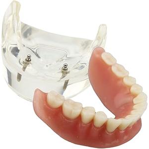 Dental Model Overdenture Inferior 2 Implants Demo for Studying and Teaching