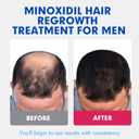 Fytikal 5% Minoxidil for Men Hair Regrowth Treatment, Extra Strength Topical Solution for Thinning Hair & Balding, Beard Growth Enhancer, Non-Greasy Fast-Absorbing Formula, 3-Month Supply