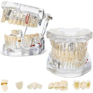 Outus Disease Teeth Model Dental Implant Teeth Model with Removable Tooth Dentist Standard Tooth Pathological Demonstration for Christmas Education Dental Supplies(Transparent,2 Pcs)