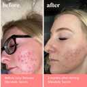 Mandelic Acid Serum Toner Exfoliant | Great For Acne Breakouts, Reduce Redness, Balancing Treatment | Plus Niacinamide, Licorice Root & Hyaluronic Acid, Hydration (Lissy Skincare)