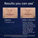 PCA SKIN 5% Benzoyl Peroxide Face Wash, Foaming Acne Facial Cleanser for Oily and Acne Prone Skin, Eliminates Existing Acne and Helps Prevent Future Breakouts, Cleanses and Calms, 7.0 Oz Bottle