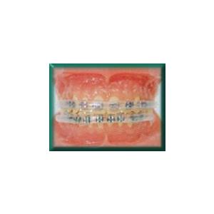 Morgan Bumper Braces Cover Lip Protector for Orthodontic Patients - Clear - Qty 2