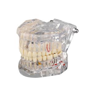 Transparent Disease Teeth Model with Dental Implant Bridge, Dental Model for Patient and Dental Student Education