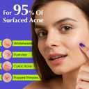 Pimple Patches For Face, Invisible Hydrocolloid Acne Patches Acne Treatment,Covering Zits & Blemishes in Skin and Face, Zit Patches with Salicylic Acid, FSA HSA Store Eligible Items 120 Count
