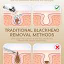 Rechargeable Blackhead Vacuum Pore Cleaner - 5 Attachments & 3 Suction Levels for Deep Facial Cleansing, USB-Powered Blackhead Remover for Women and Men (White)