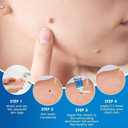 Wart Removal Cream 20g, Effective Treatment of Warts, Corns Spot Moles, Moles and Calluses, Wart Remover Cream for Body and Hands