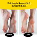 PedEgg Foot File Traps Shavings Inside for Mess-Free Use Painless Callus Remover with Ergonomic Handle for Tough, Dry Skin & Smooth, Soft Feet