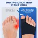 2PCS Bunion Corrector for Women & Men - Toe Alignment Corrector with Splint & Pad for Hallux Valgus Pain Relief, Toe Separator for Day/Night Support, Anti Slip Gel Strap for Big Toe Straightener(Gray)