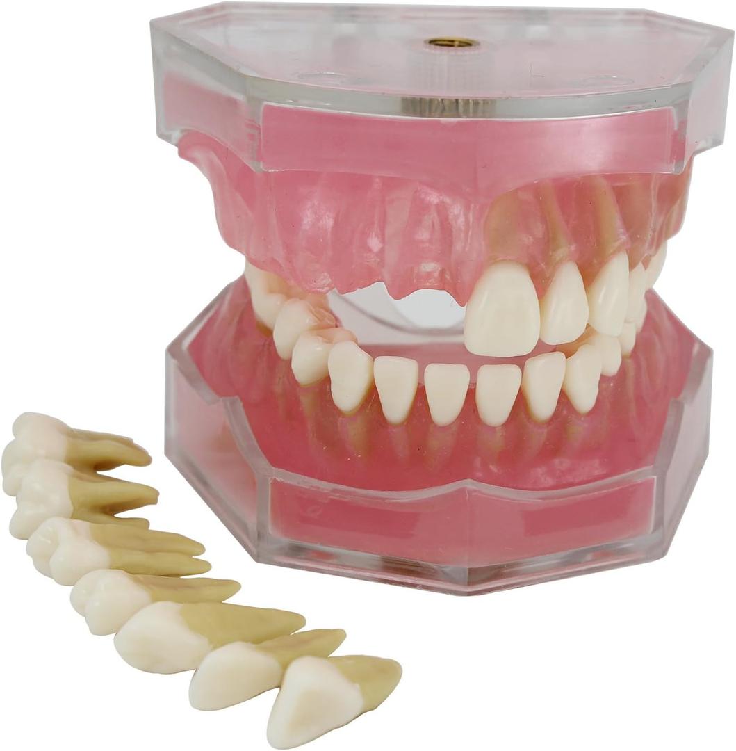 Dental Implant Teeth Model with Removable Teeth for Dental Professionals and Students
