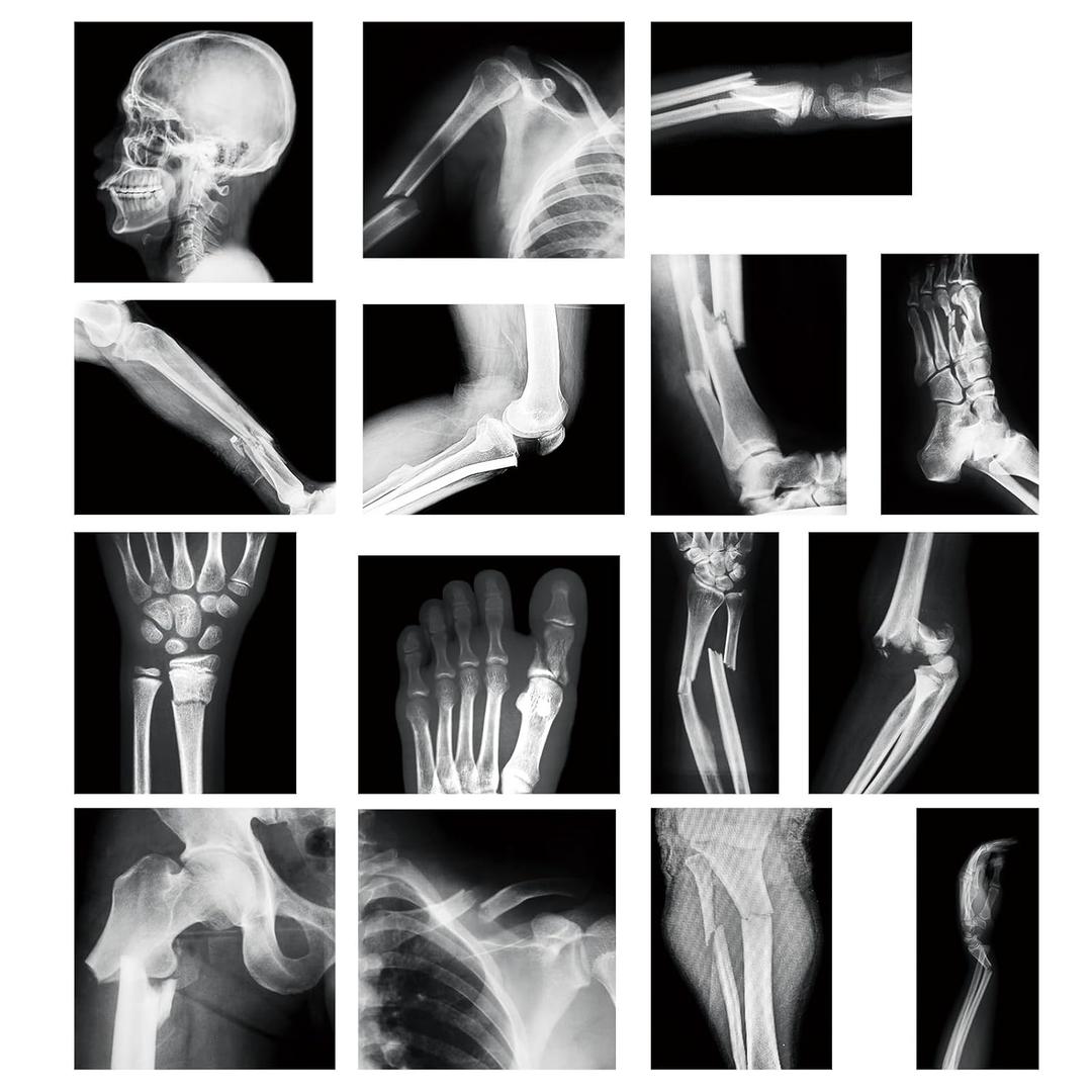 15 Pcs Broken Bones x Ray Set Human x Rays Black and White Skeleton Pretend Xrays for Kids